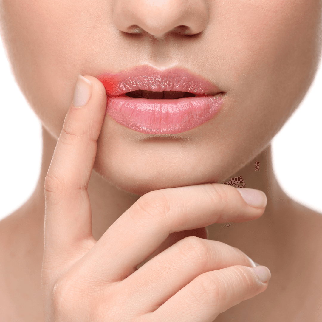 Natural Remedies for Cold Sores